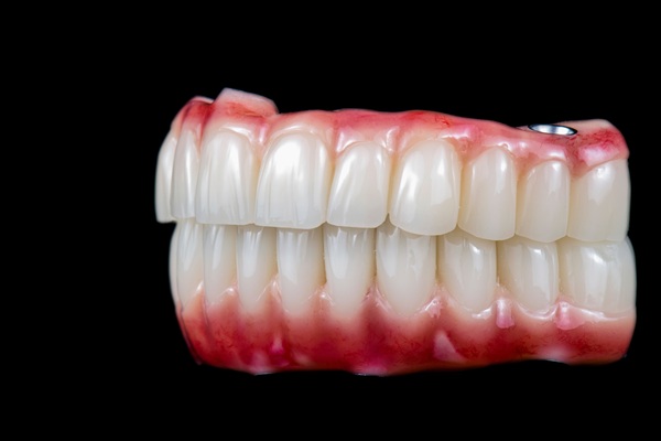 All On   Can Replace Multiple Teeth