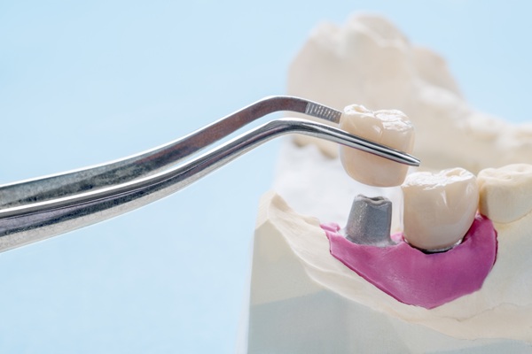 Material Options For Dental Crowns