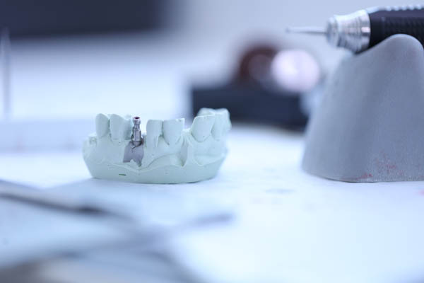 Who Needs A Dental Implant Restoration?