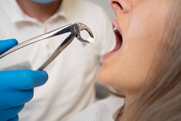 Tooth Extraction Rancho Cucamonga, CA