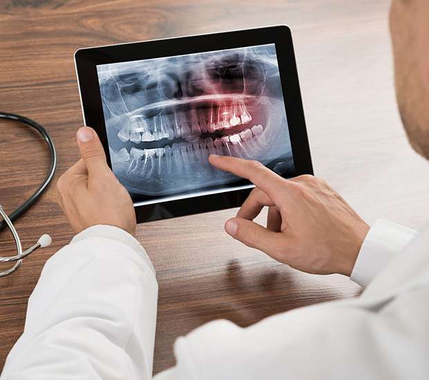 Rancho Cucamonga Types of Dental Root Fractures